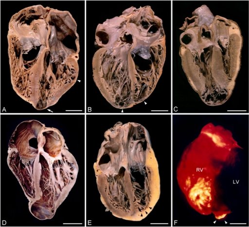 The chronic phase can last years, frequently unnoticed, and involves irreversible damage to the heart, intestines, and nervous system, often culminating in debilitating health complications and death. Above: Gross pathology of chronic Chagas cardiomyopathy (Image: eMedMD)